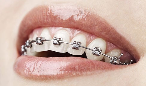 typesofbraces